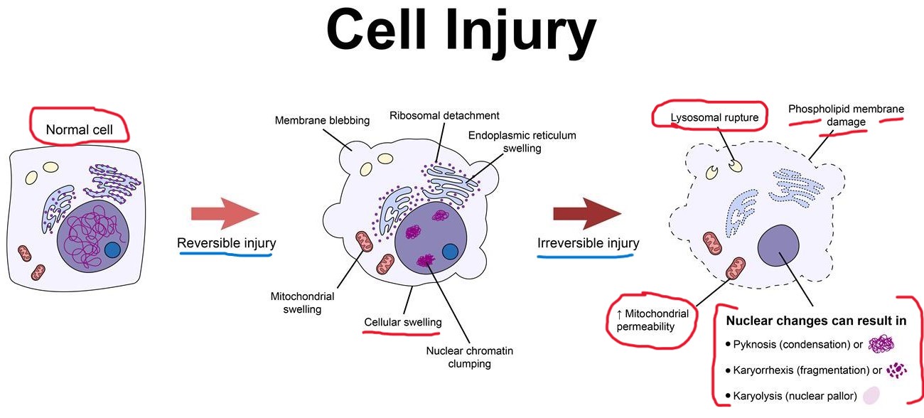 Cell Injury apoptosis necrosis